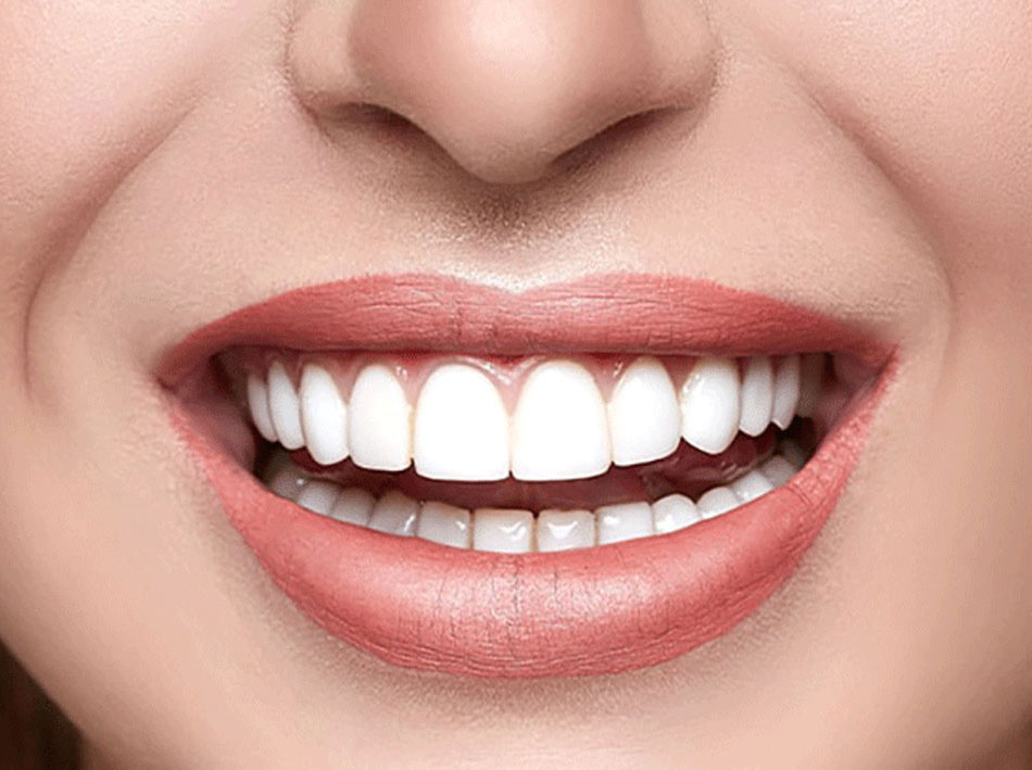 Zahnbleaching Ittingen
